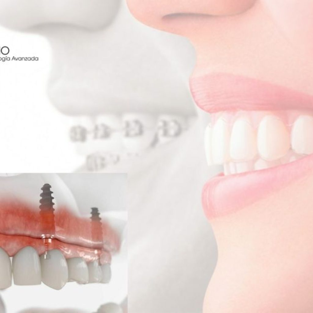 Cuidados dentales cercanos en Pozuelo con atención profesional Cuidados dentales cercanos en Pozuelo con atención profesional