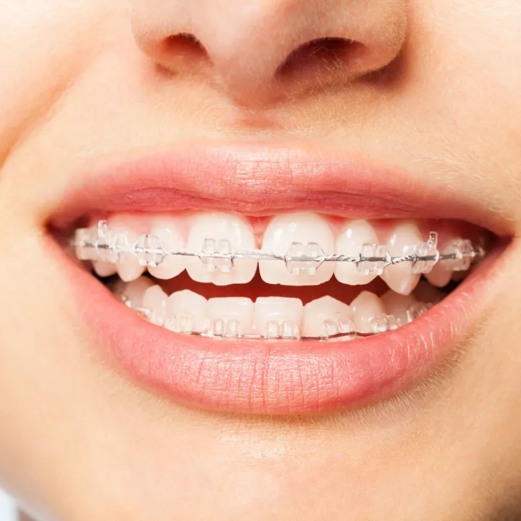 What to Expect: Invisalign Cost and Timelines Explained What to Expect: Invisalign Cost and Timelines Explained